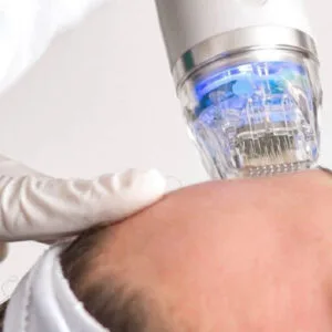 Fractional Rf Microneedling