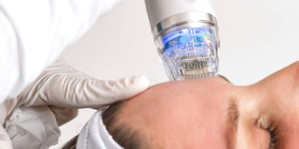 Fractional Rf Microneedling